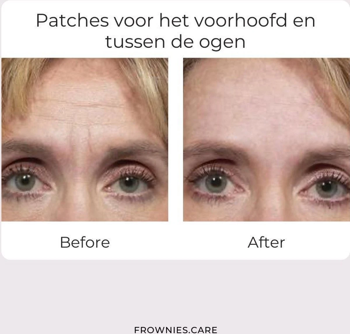 Frownies | Patches Voor Het Voorhoofd En Tussen De Ogen - 100% Natuurlijk (144 Stuks) 2 Frownies | Patches Voor Het Voorhoofd En Tussen De Ogen - 100% Natuurlijk (144 Stuks) - Afbeelding 2