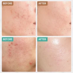 Jinius ® - Pimple Patches - Pimple Patch - Acne Patch - Puisten Verwijderaar - Puisten Pleister - Acne Pleister - Acne Sticker - Puistjes Verwijderen - 108 Stuks 6 Jinius ® - Pimple Patches - Pimple Patch - Acne Patch - Puisten Verwijderaar - Puisten Pleister - Acne Pleister - Acne Sticker - Puistjes Verwijderen - 108 Stuks -Goedkope Gezicht Zoet Winkel 1200x1200 588