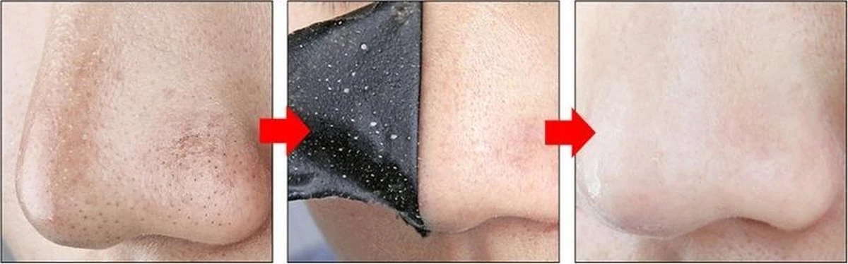 Merkloos Peel Off Mask - Mee-eters Verwijderen - Neus - 20 Strips - Neusstrip - Puistjes - Charcoal - Acne - Acne Behandeling - Diepe Reiniging - Blackhead - Poriën - Mee-eter - Verwijderen 2 Merkloos Peel Off Mask - Mee-eters Verwijderen - Neus - 20 Strips - Neusstrip - Puistjes - Charcoal - Acne - Acne Behandeling - Diepe Reiniging - Blackhead - Poriën - Mee-eter - Verwijderen - Afbeelding 2