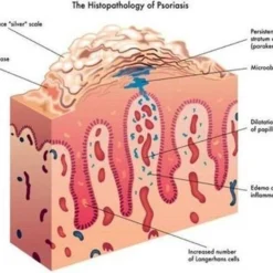 Psoriasis/exzeem Chineese Creme 12 Psoriasis/exzeem Chineese Creme -Goedkope Gezicht Zoet Winkel 1200x919